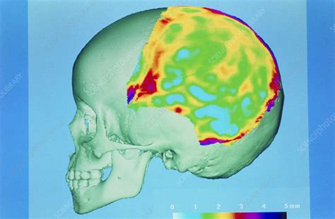 measuring skull thickness|thickness of human skull.